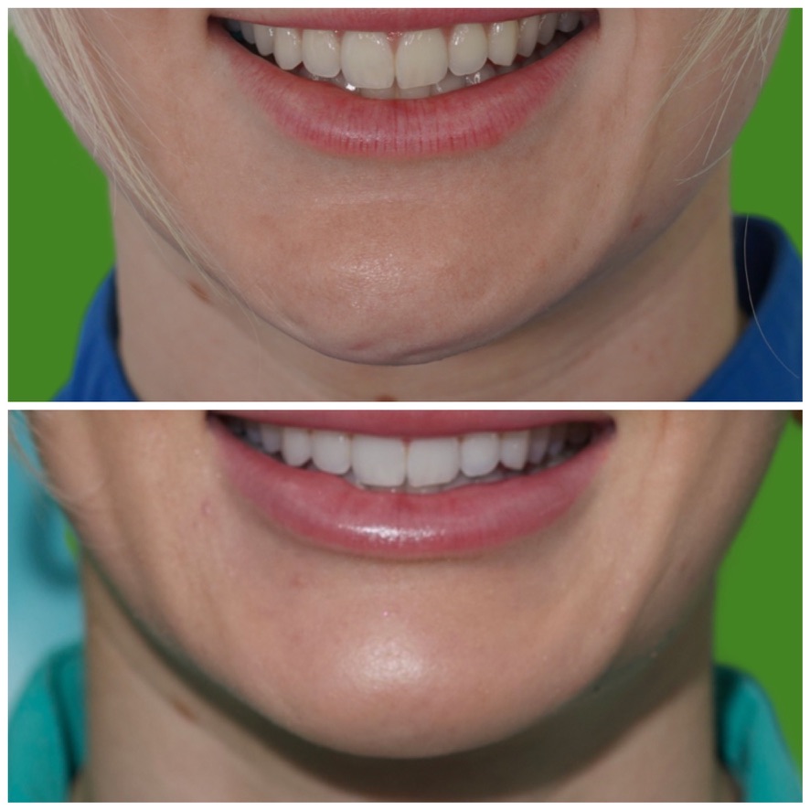 Lip filler before and after — smile and tooth show Smiling before and after lip filler results showing a fuller upper lip and better tooth show after treatment at Petro Facial Plastic Surgery