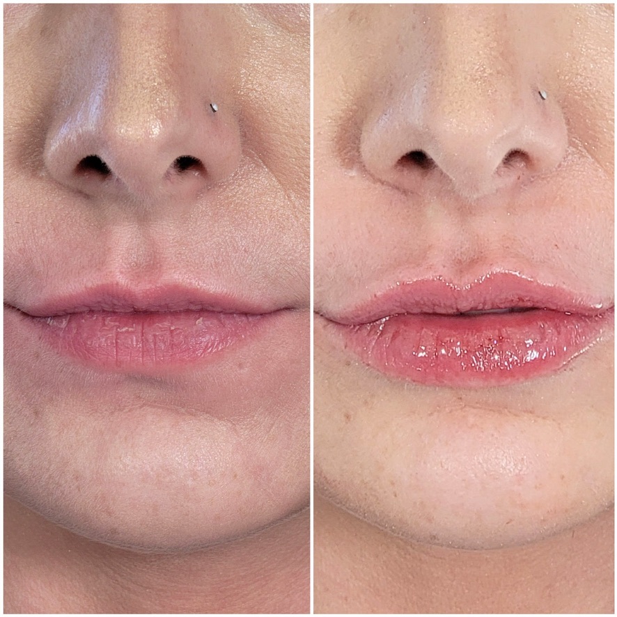 Lip filler before and after — mature lip restoration Before and after dermal filler restoring lip volume and softening smoker's lines around the mouth in a mature patient in Birmingham, AL