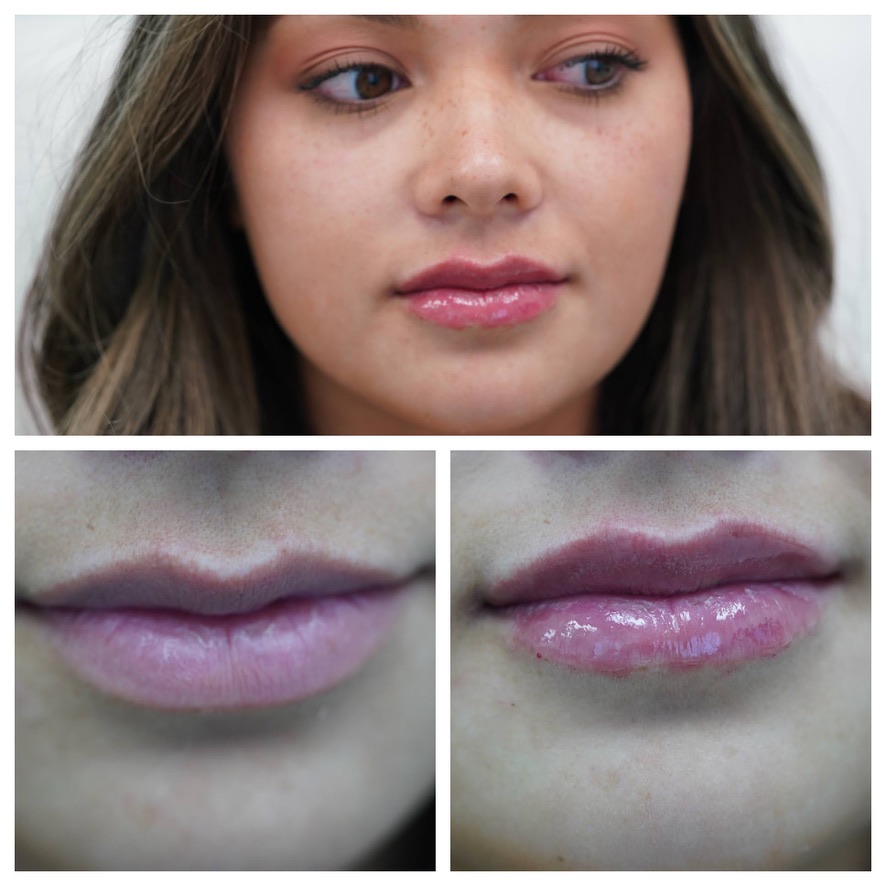 Lip filler before and after — subtle volume, defined border Before and after lip filler on a young woman showing a fuller, glossier lip with a defined cupid's bow, treated by Dr. Melanie Petro in Vestavia Hills, Alabama