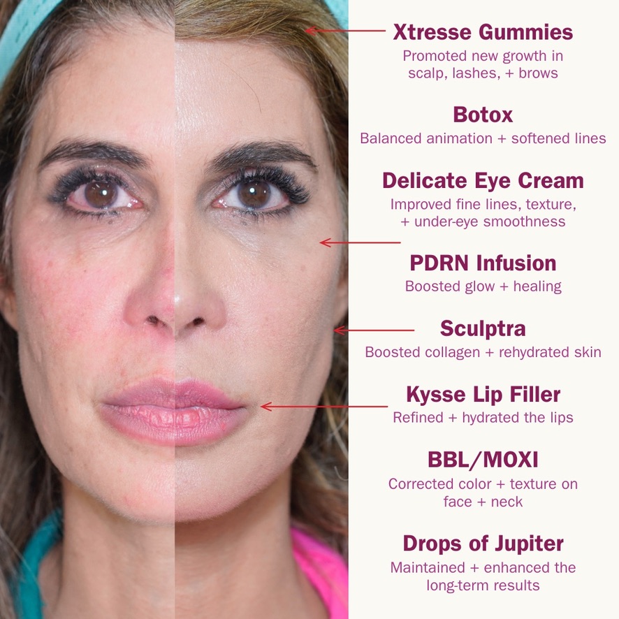 Full-face treatment plan before and after Full-face before and after results labeled by treatment: Botox for balanced animation, Sculptra for collagen, Restylane Kysse lip filler, BBL and MOXI for color and texture, PDRN infusion for glow