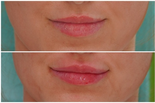 Lip filler before and after — symmetry Before and after lip filler close-up showing symmetric, natural lip enhancement in a patient of Dr. Melanie Petro in Vestavia Hills, AL