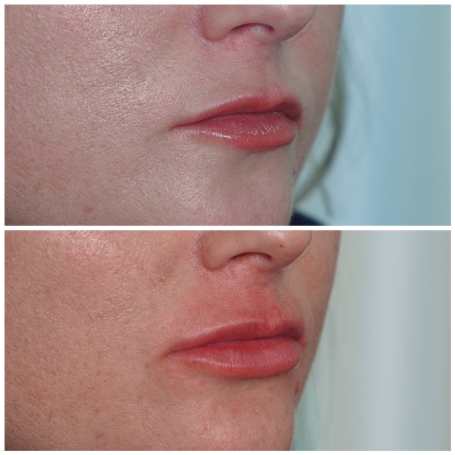 Lip filler before and after — profile view Three-quarter view before and after lip filler showing improved lip projection and vermilion border in Birmingham, Alabama