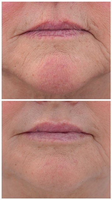 Perioral lines before and after dermal filler Before and after dermal filler treatment of perioral lip lines and chin creasing in a mature patient at Petro Facial Plastic Surgery, Birmingham AL