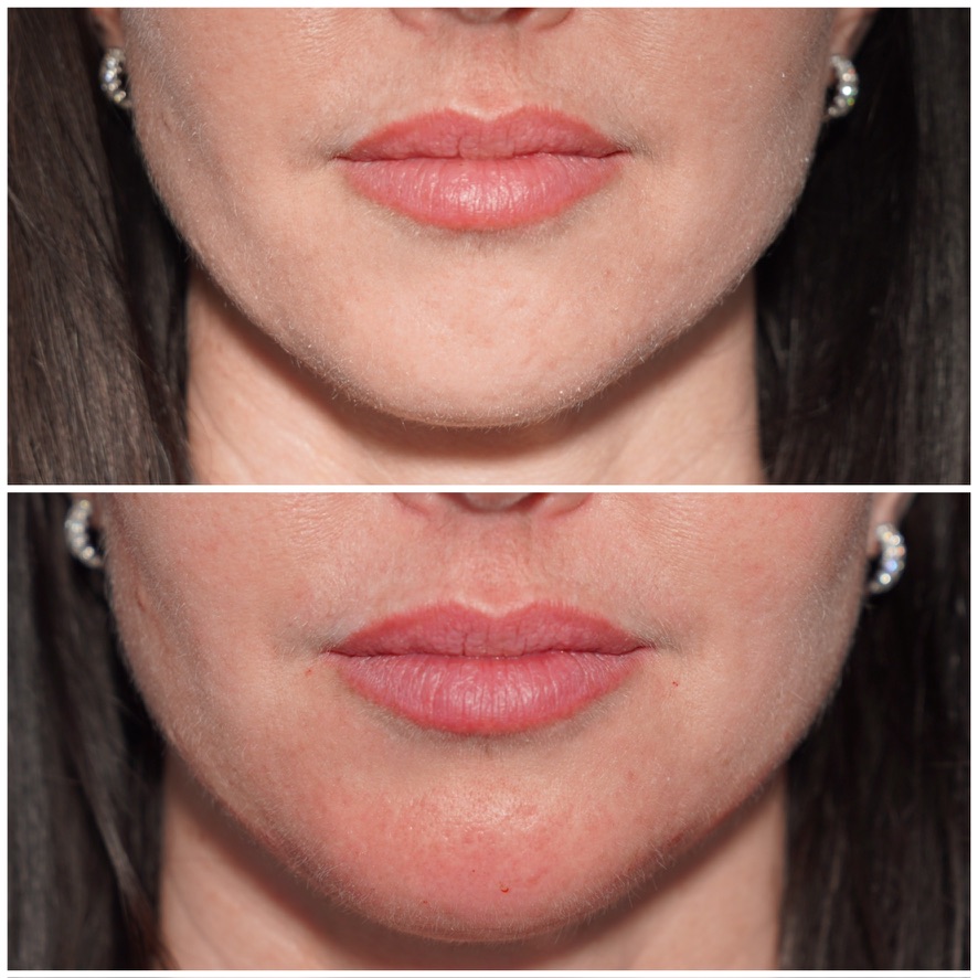 Lip filler before and after — proportion and definition Before and after lip filler photo showing improved lip proportion and definition in a dark-haired patient treated in Birmingham, Alabama