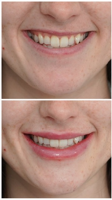 Lip filler before and after — upper lip shaping Before and after lip filler on a smiling patient showing a fuller, well-shaped upper lip treated at Petro Facial Plastic Surgery, Vestavia Hills