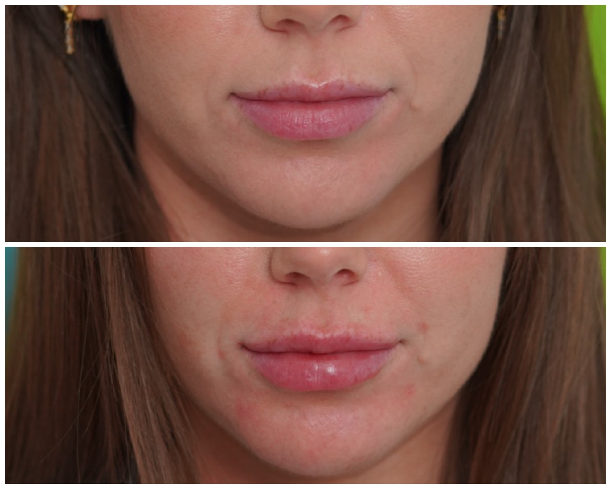 Lip filler before and after — natural volume and definition Before and after lip filler results showing a subtly fuller, more defined upper and lower lip on a young woman treated by Dr. Melanie Petro in Birmingham, Alabama