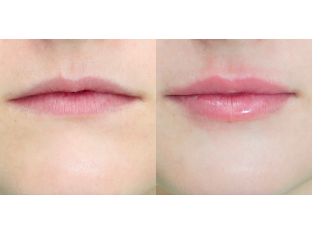 Lip filler before and after — shape and hydration Side by side lip filler before and after photo showing improved lip shape, hydration and a defined vermilion border after treatment in Vestavia Hills, AL